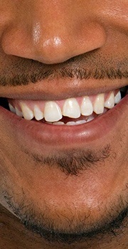 man's chipped tooth