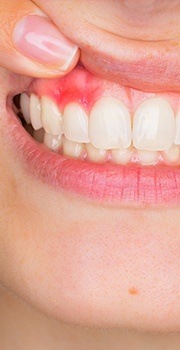 Woman's red irritated gums